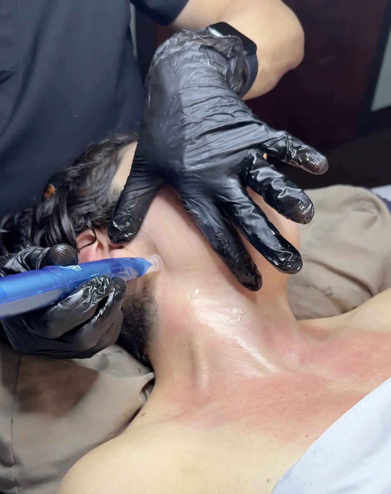 Microneedling